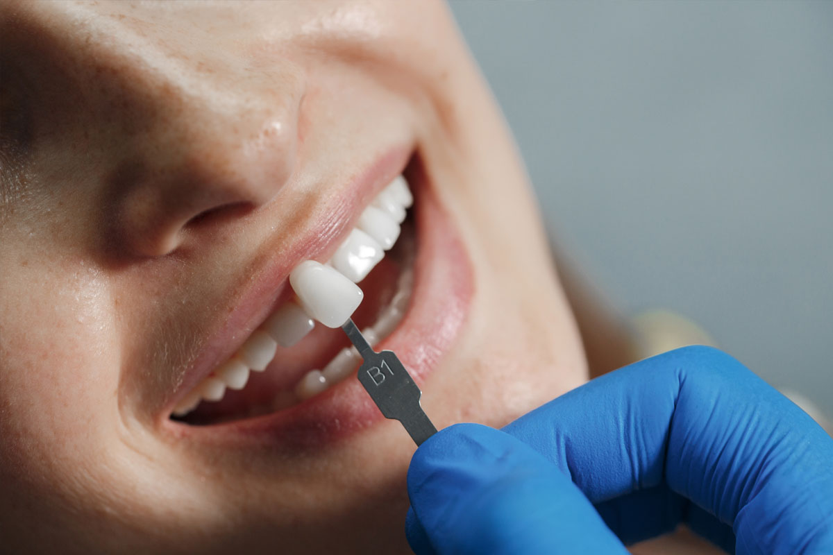 carilla-dental-madrid-dentista-junio2023.jpg