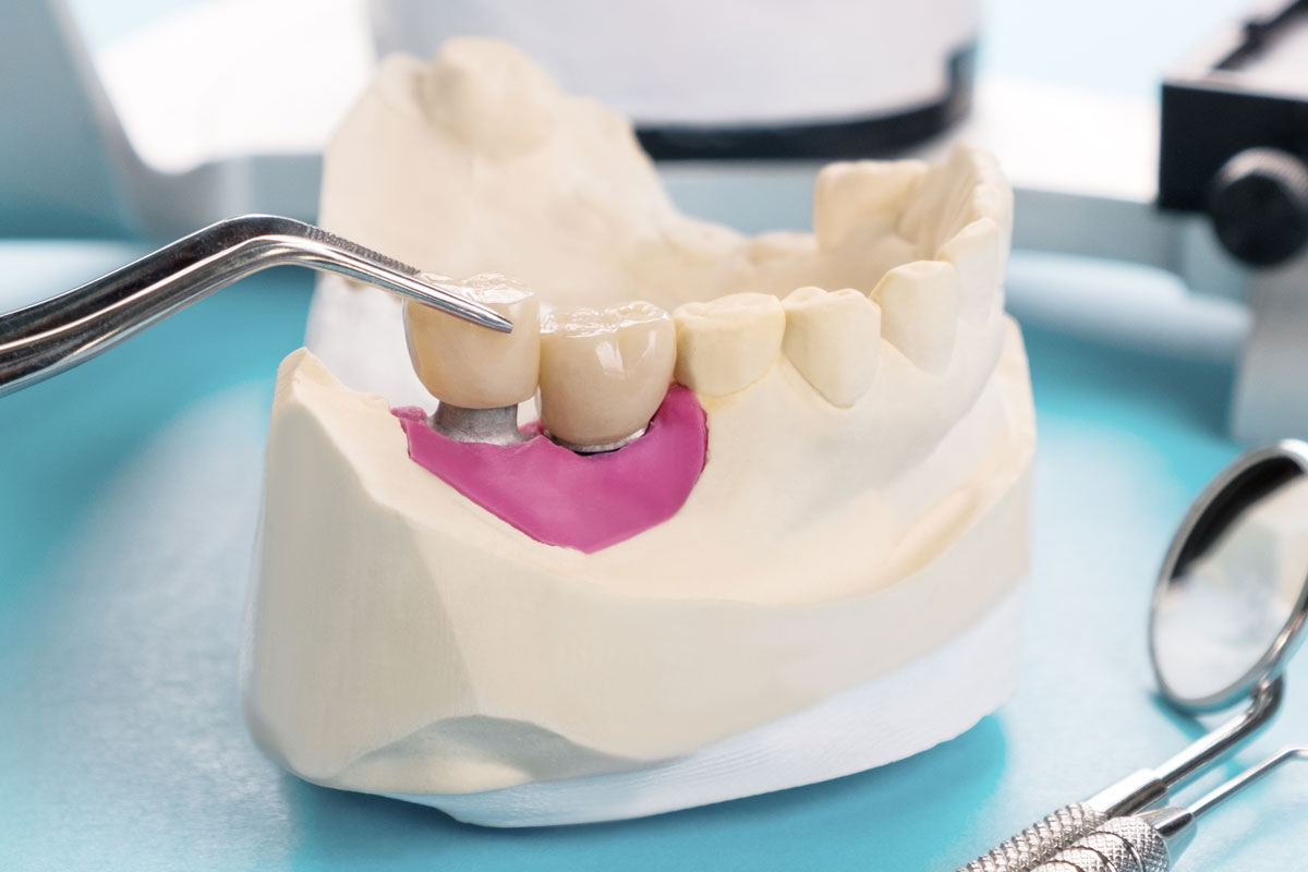 implante-hueso-dental-madrid-dentista-noviembre2023.jpg
